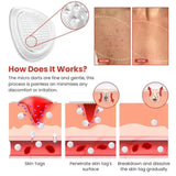 DermaSmooth Painless Skin Tag Removal Patch